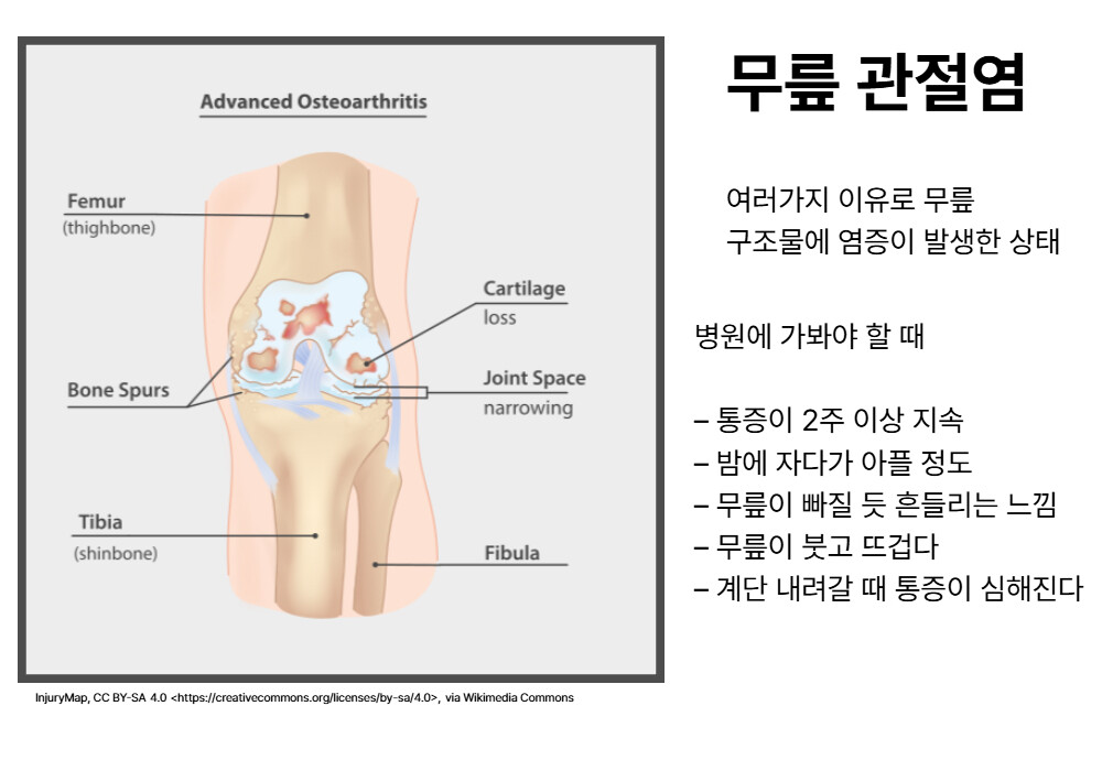 무릎 골관절염 병원에 가봐야 할 때